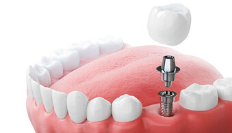 diagram of a dental implant showing its parts