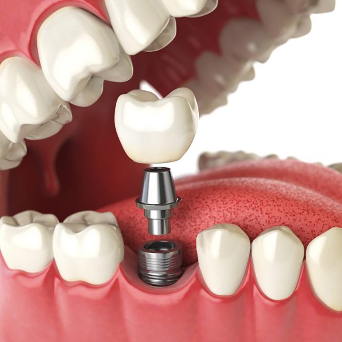 a 3D illustration of a dental implant